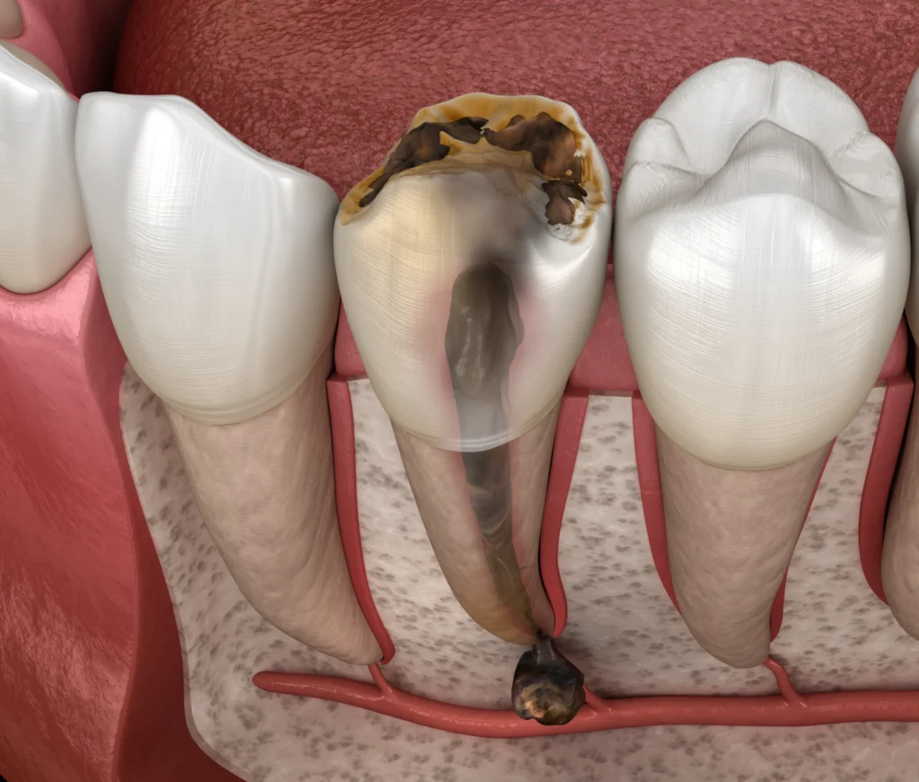 Chirurgie endodontique