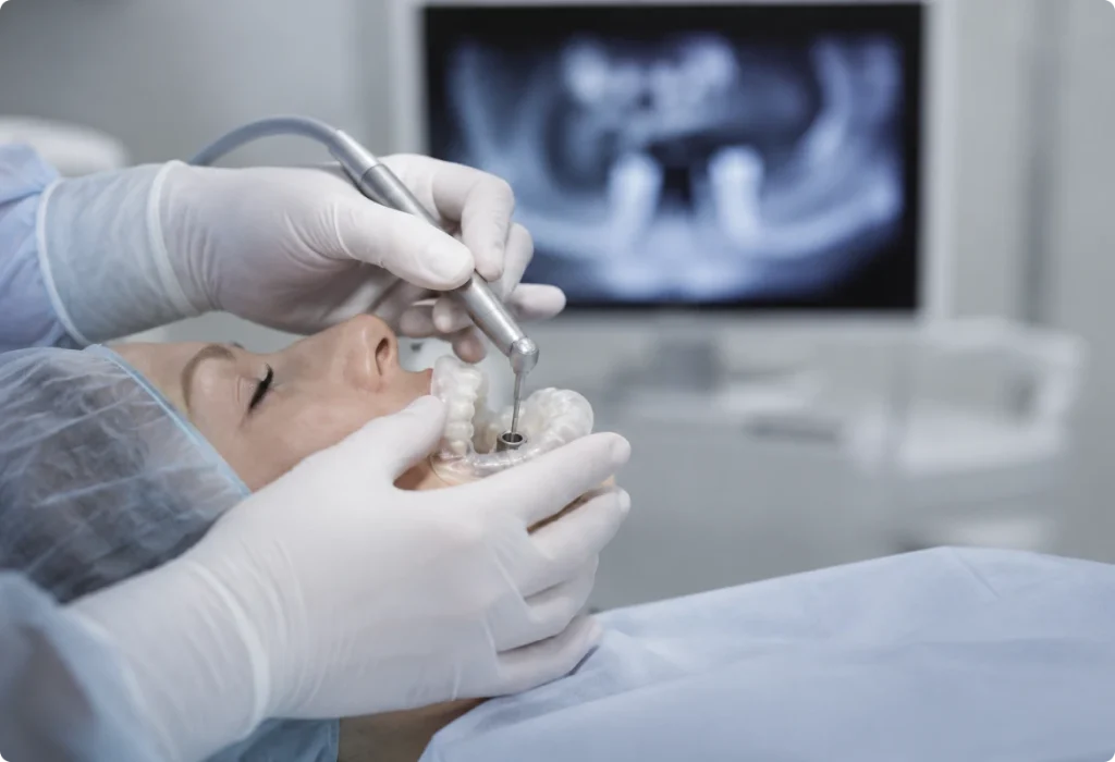 Chirurgie implantaire guidée