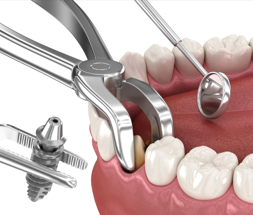 Extraction implantation immédiate