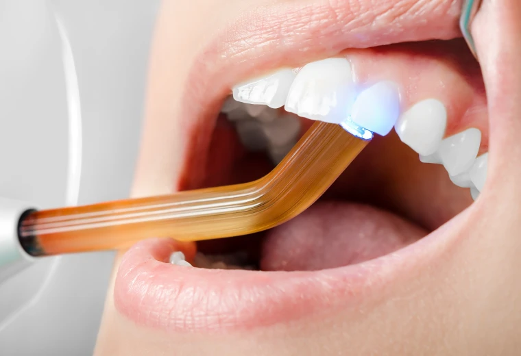 Restauration dentaire par résine composite photopolymérisée après traitement endodontique