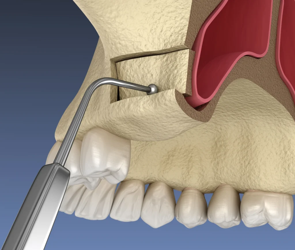Sinus lift