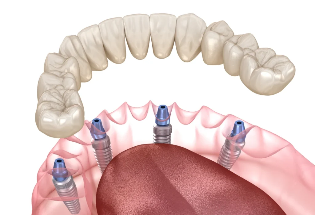 All-on-4 : prothèse complète sur quatre implants dentaires