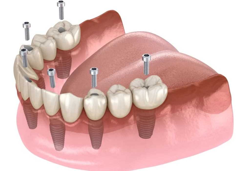 All-on-6 : prothèse complète sur six implants dentaires
