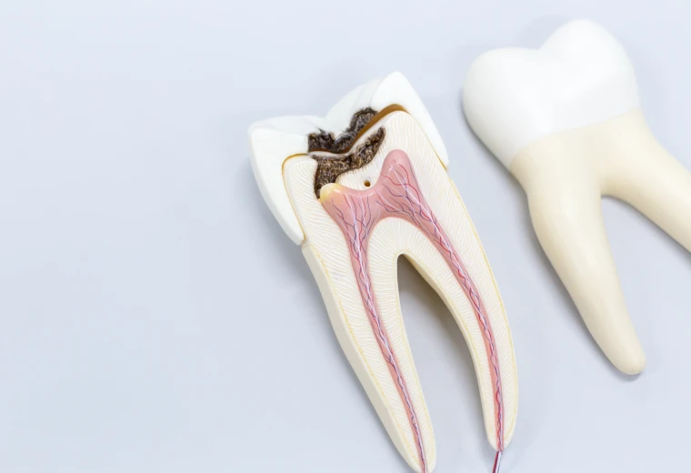 Modèles anatomiques de racines dentaires utilisés en chirurgie endodontique