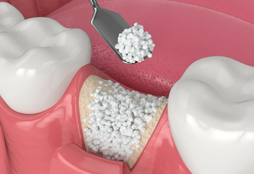comblement-alveolaire-extraction-dentaire