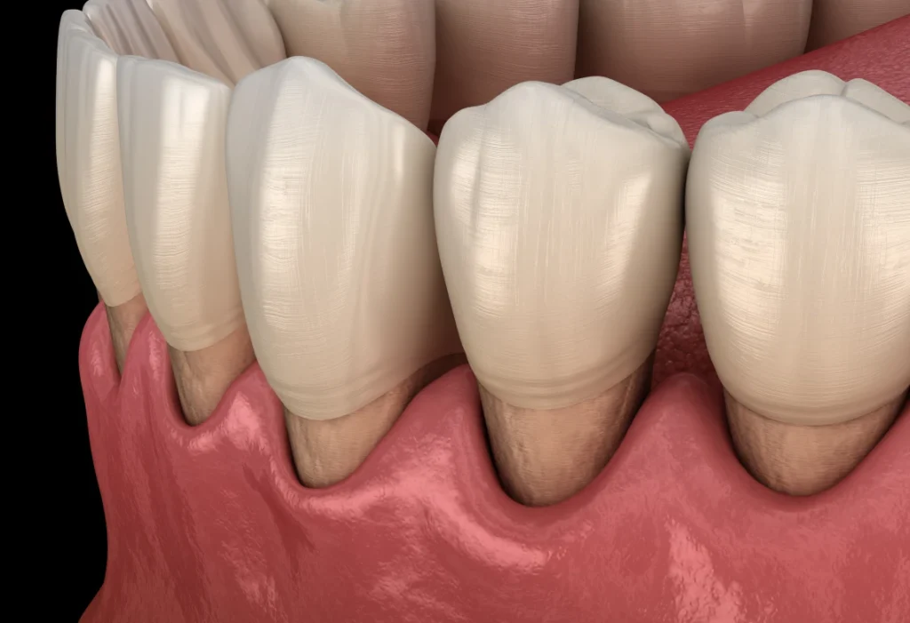 Illustration montrant une récession gingivale avec racines dentaires exposées