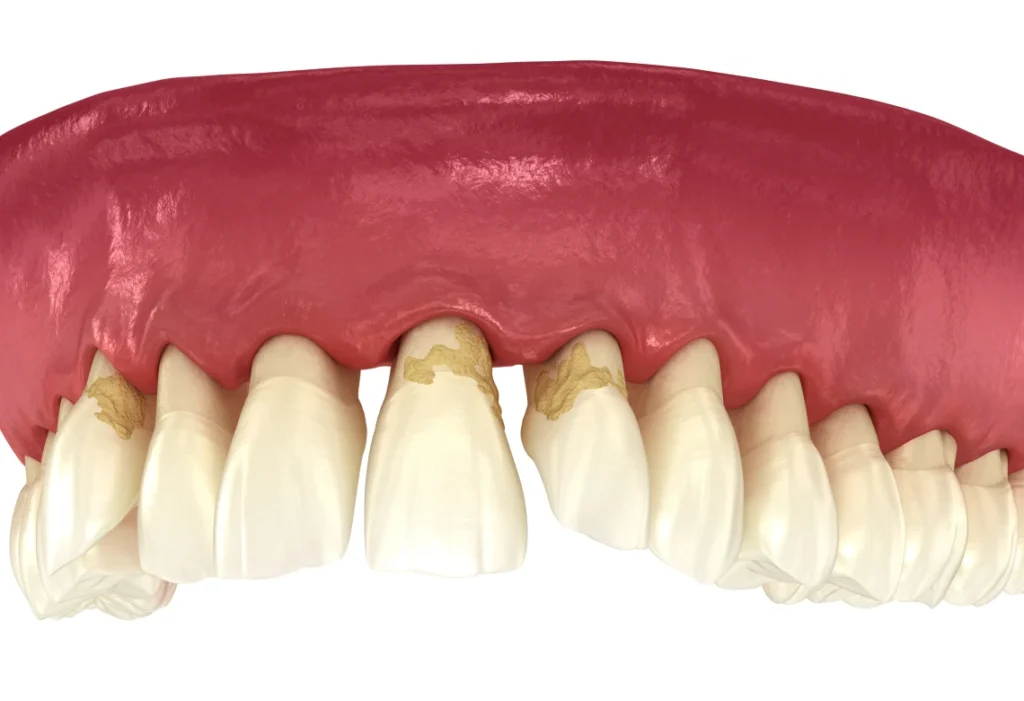 Illustration 3D d'un déchaussement dentaire