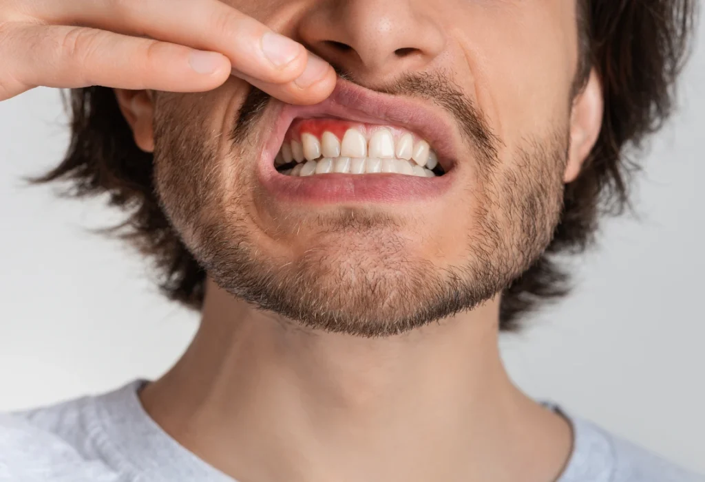 Homme présentant une inflammation gingivale nécessitant une greffe de gencive