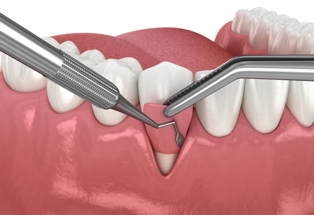 Illustration 3D du geste chirurgical lors d'une greffe de gencive