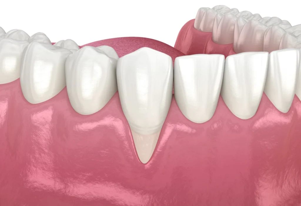 Illustration 3D d'une récession gingivale avant une greffe de gencive