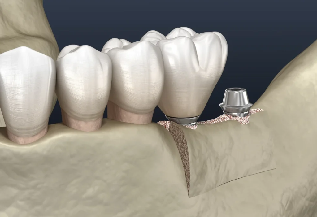 Comparaison entre volume osseux naturel et zone d'os résorbé avant implant dentaire