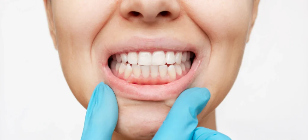 Examen clinique des gencives dans le cadre d'un dechaussement dentaire