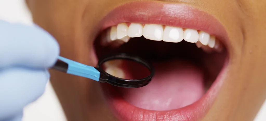 Praticien examinant la bouche du patient avec un miroir dentaire lors d'un surfaçage radiculaire